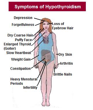 Hypothyroidism-Symptoms-in-women